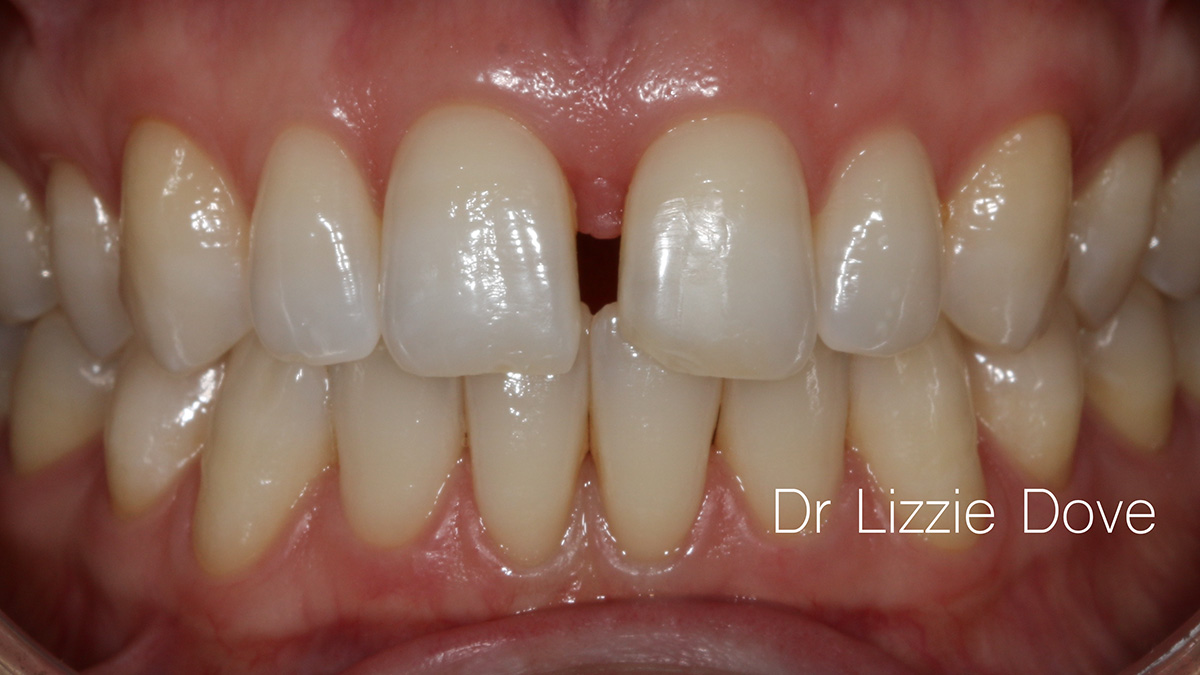 Before — gap between upper front teeth