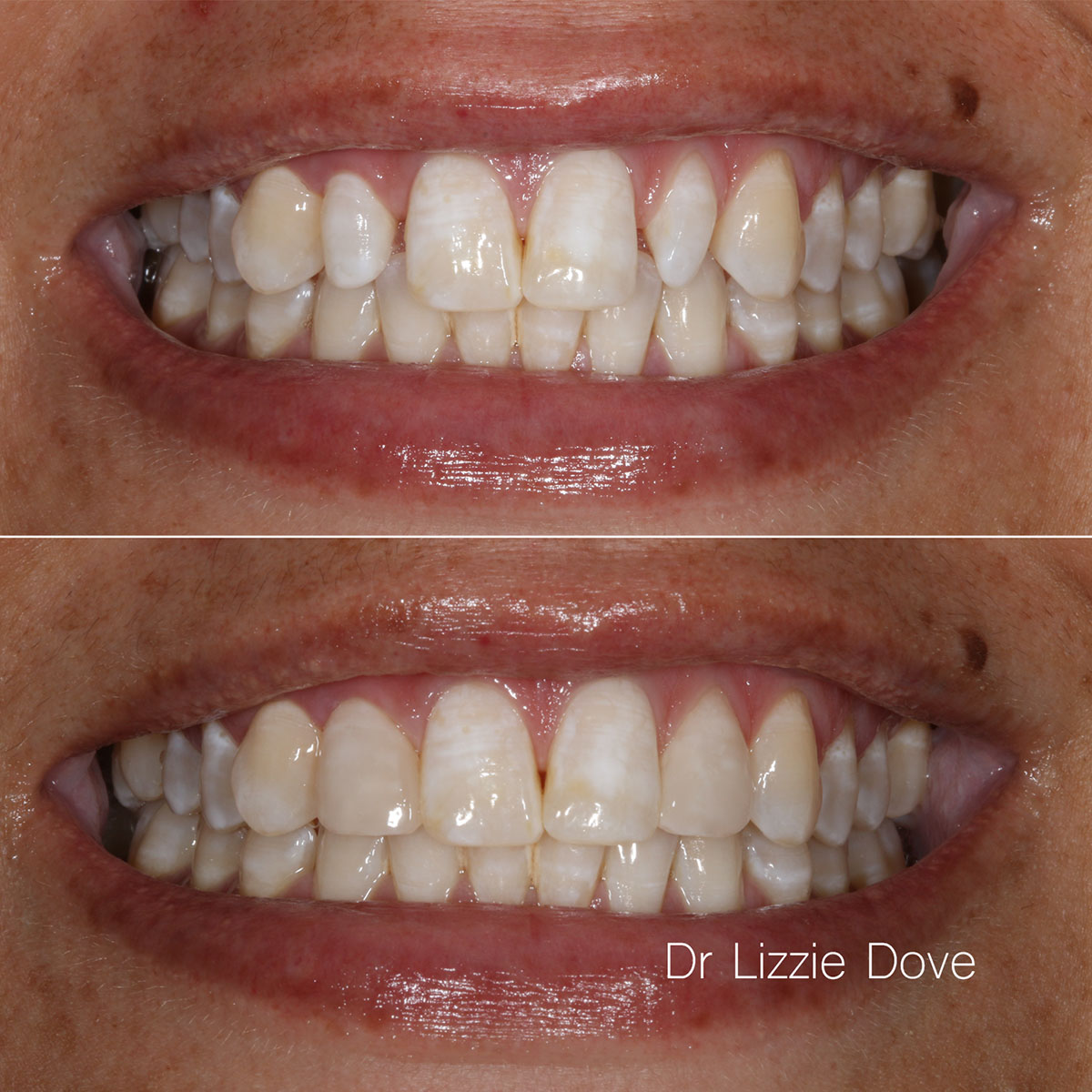 Before — peg lateral incisors