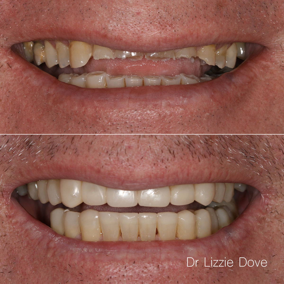 Before — severely worn dentition