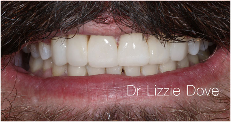 Invisalign and composite bonding case, after result, smile view