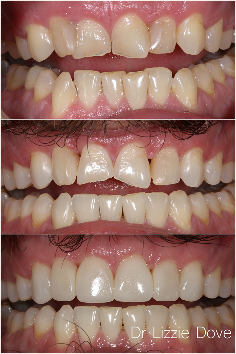 Invisalign and composite bonding case, before, mid-treatment and after, front view