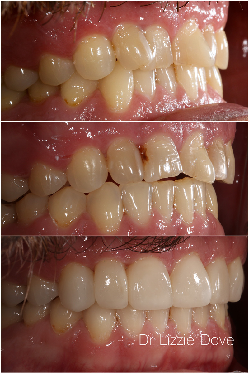 Invisalign and composite bonding case, before, mid-treatment and after, side view