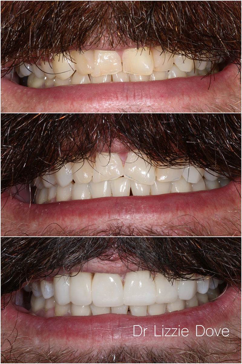 Before — severe crowding with uneven wear