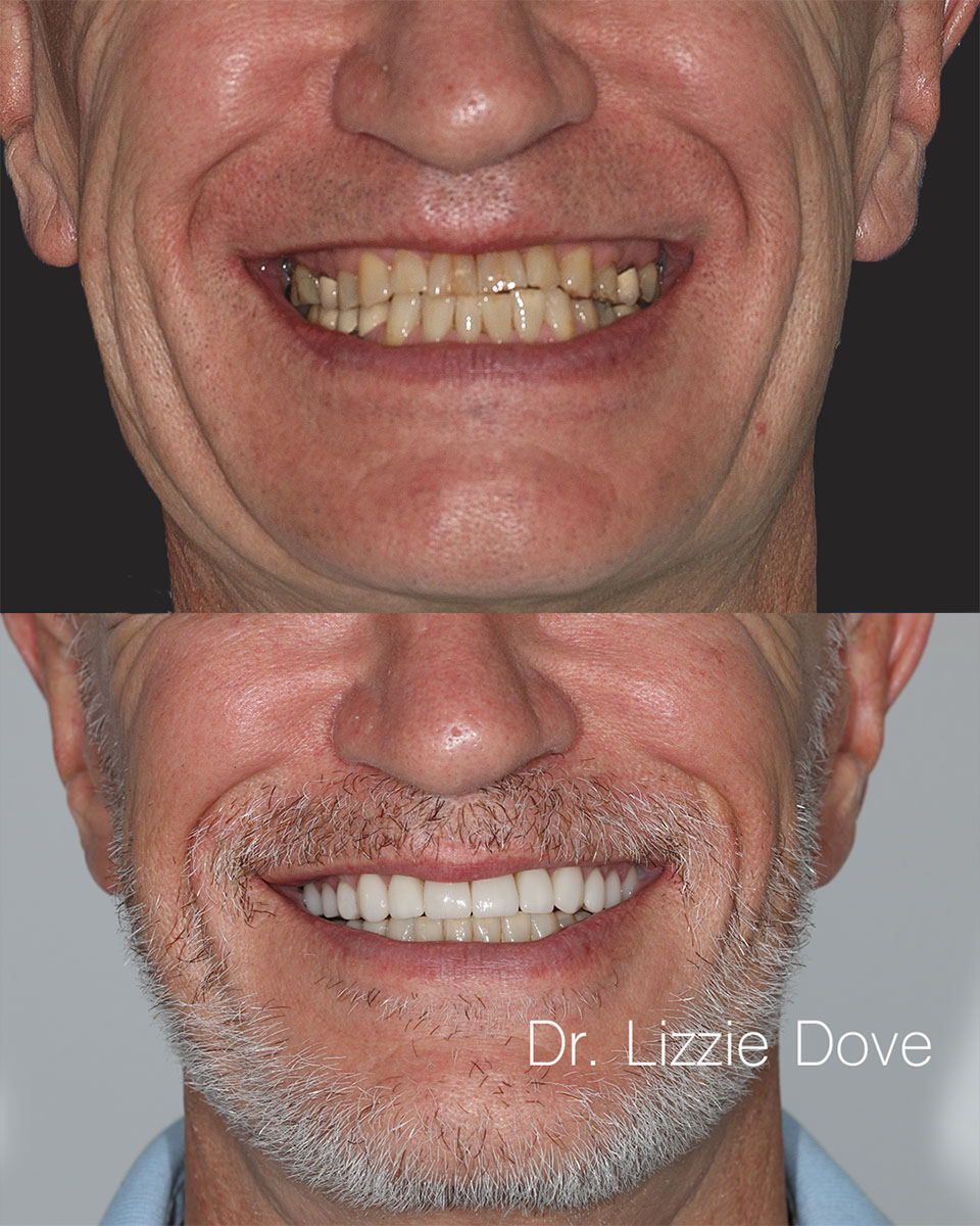 Before — edge-to-edge bite with severe wear
