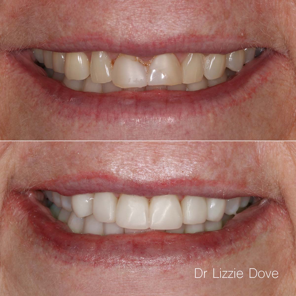 Before — broken and stained composite veneers with crowding