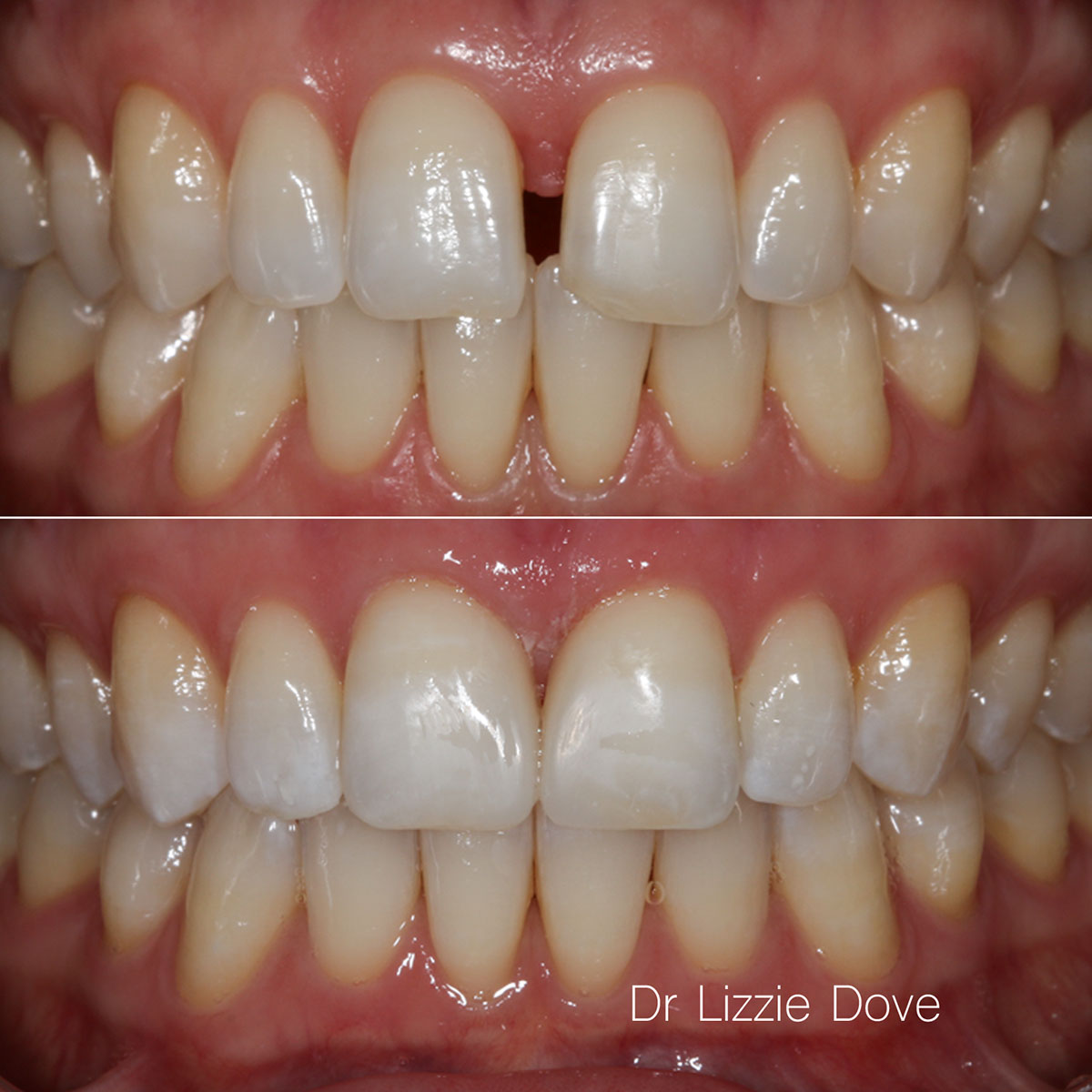 Composite bonding before and after Gold Coast – Dr Lizzie Dove