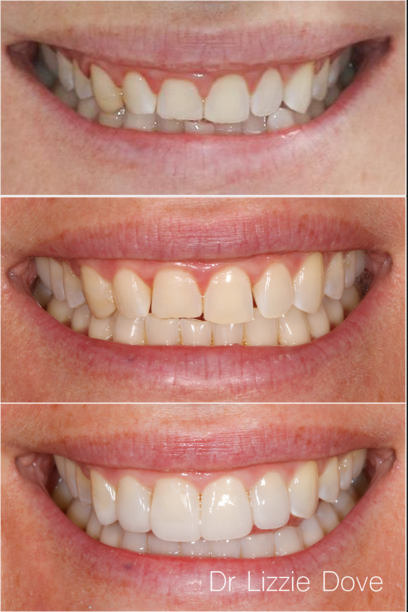 Invisalign and composite bonding before, mid-treatment and after – Dr Lizzie Dove Gold Coast