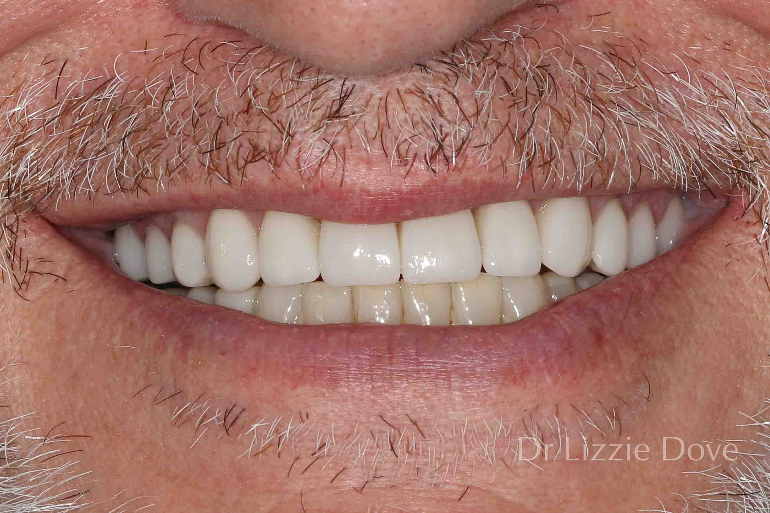 Porcelain veneers result Gold Coast – Dr Lizzie Dove